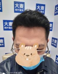 体验后-大麦微针植发丨全国连锁