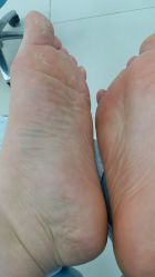 -派恩宜灰指甲鸡眼嵌甲手足癣