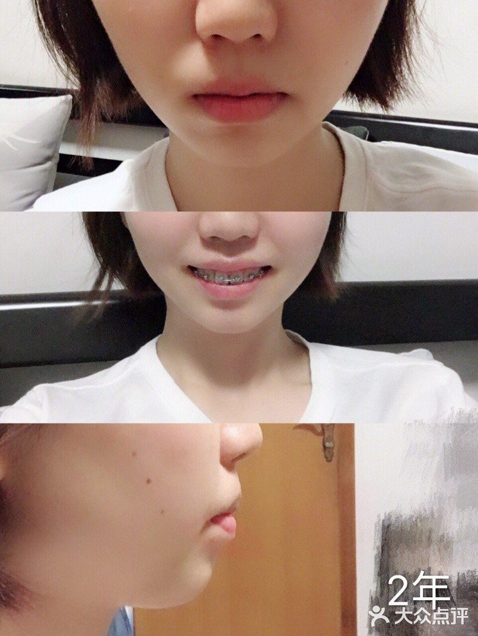 骨性深覆合金属自锁矫正案例 