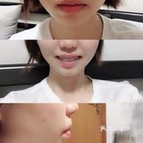 骨性深覆合金属自锁矫正案例 