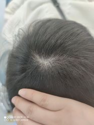 -大麦微针植发全国连锁