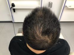 点击看大图 -大麦微针植发全国连锁