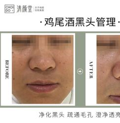 -清颜堂丨分子祛痘·功效美肤