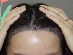 点击看大图 -大麦微针植发全国连锁