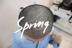 点击看大图 -大麦微针植发全国连锁