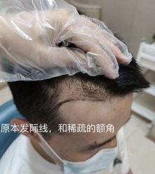 体验前-大麦微针植发全国连锁