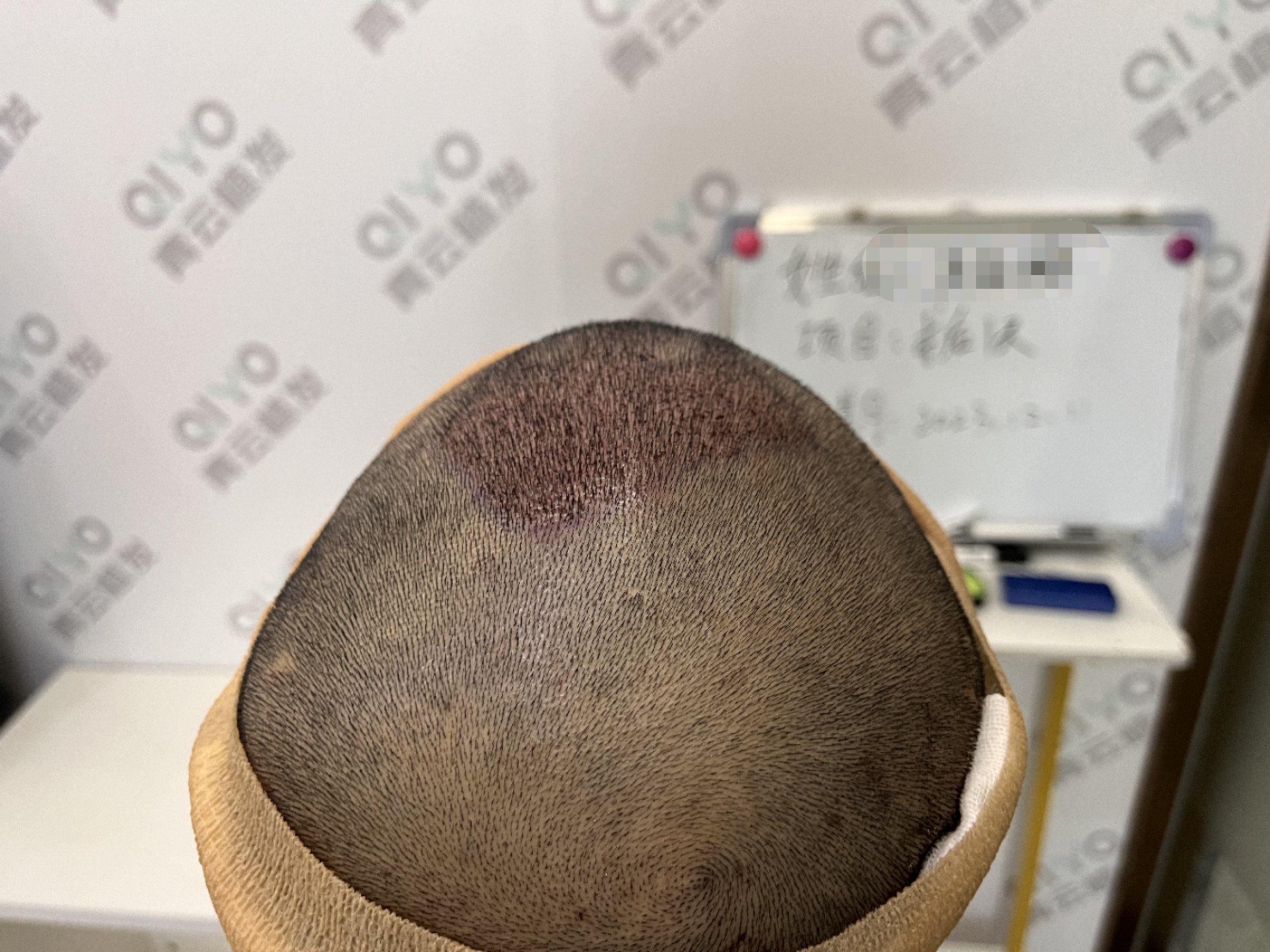 植发裹纱布(植发后纱布粘在后枕部粘住怎么办)
