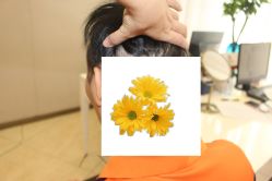 -大麦微针植发丨全国连锁