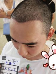 点击看大图 -大麦微针植发丨全国连锁