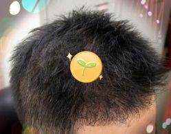 -大麦微针植发全国连锁