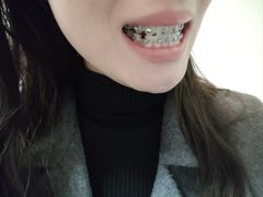 -上海仁爱医院口腔科 · 种植