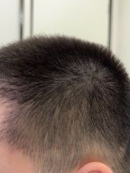 -大麦微针植发丨全国连锁