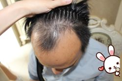 -大麦微针植发丨全国连锁