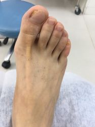 -派恩宜灰指甲鸡眼嵌甲手足癣