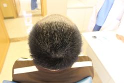 -大麦微针植发丨全国连锁