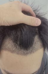 -大麦微针植发丨全国连锁