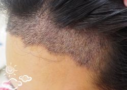 -大麦微针植发丨全国连锁