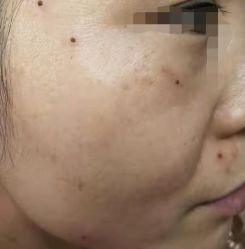 -北京美痣堂古方祛痣斑疣瘊