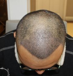 -大麦微针植发丨全国连锁