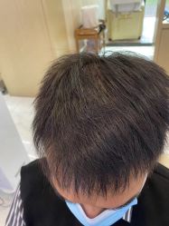 -大麦微针植发丨全国连锁