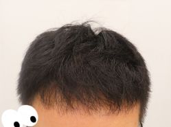 -大麦微针植发全国连锁