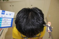 -大麦微针植发丨全国连锁