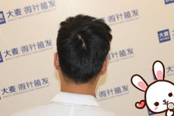 点击看大图 -大麦微针植发丨全国连锁