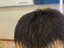 -碧莲盛·不剃发植发