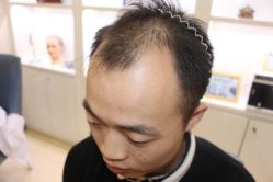 -大麦微针植发丨全国连锁