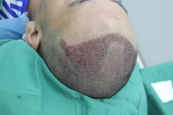 -大麦微针植发丨全国连锁