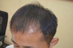 -大麦微针植发丨全国连锁