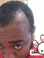 -大麦微针植发丨全国连锁