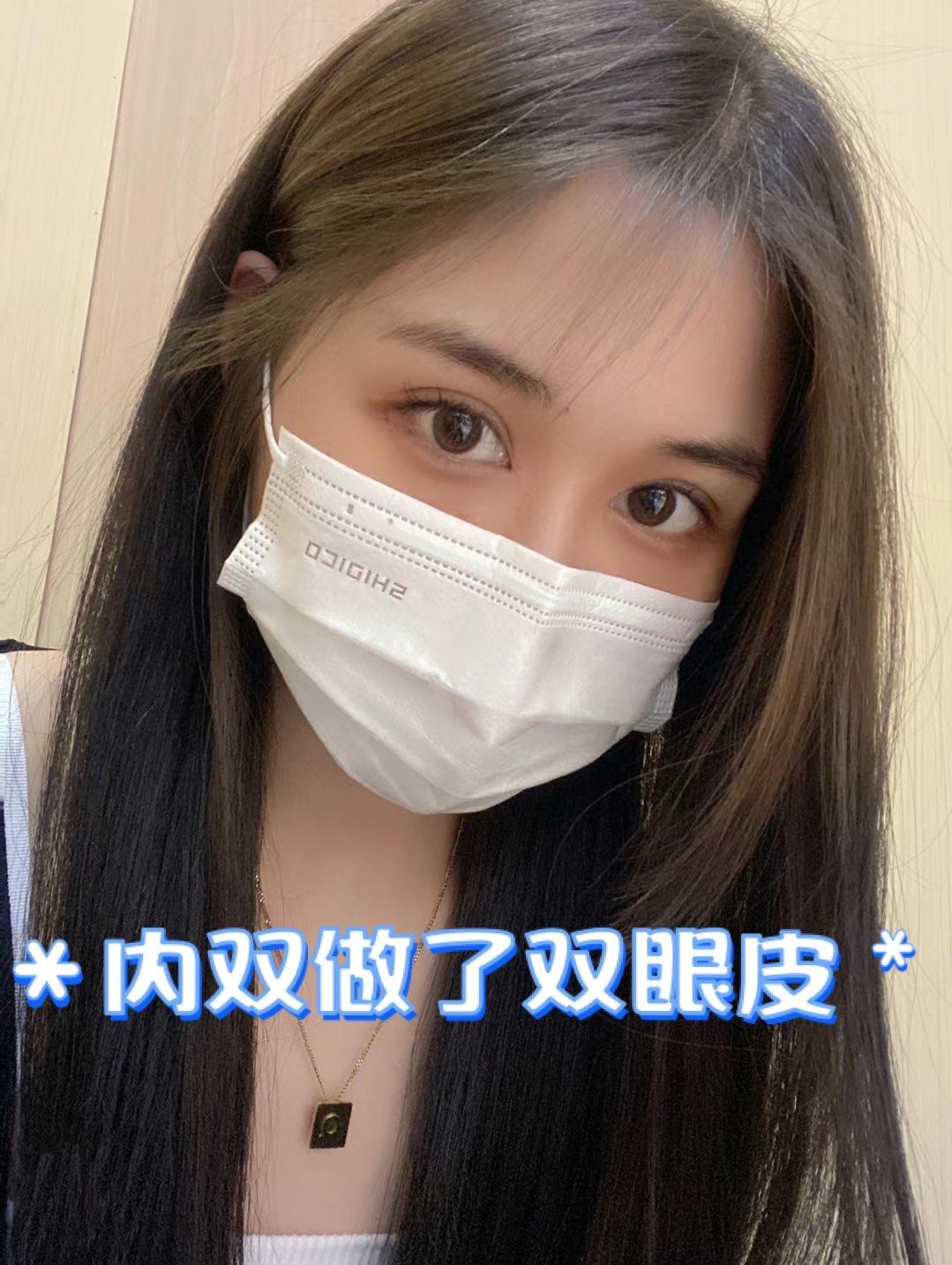 做的双眼皮很自然