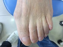 -德哥灰指甲脚气甲沟炎跖疣护理