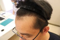 -大麦微针植发丨全国连锁