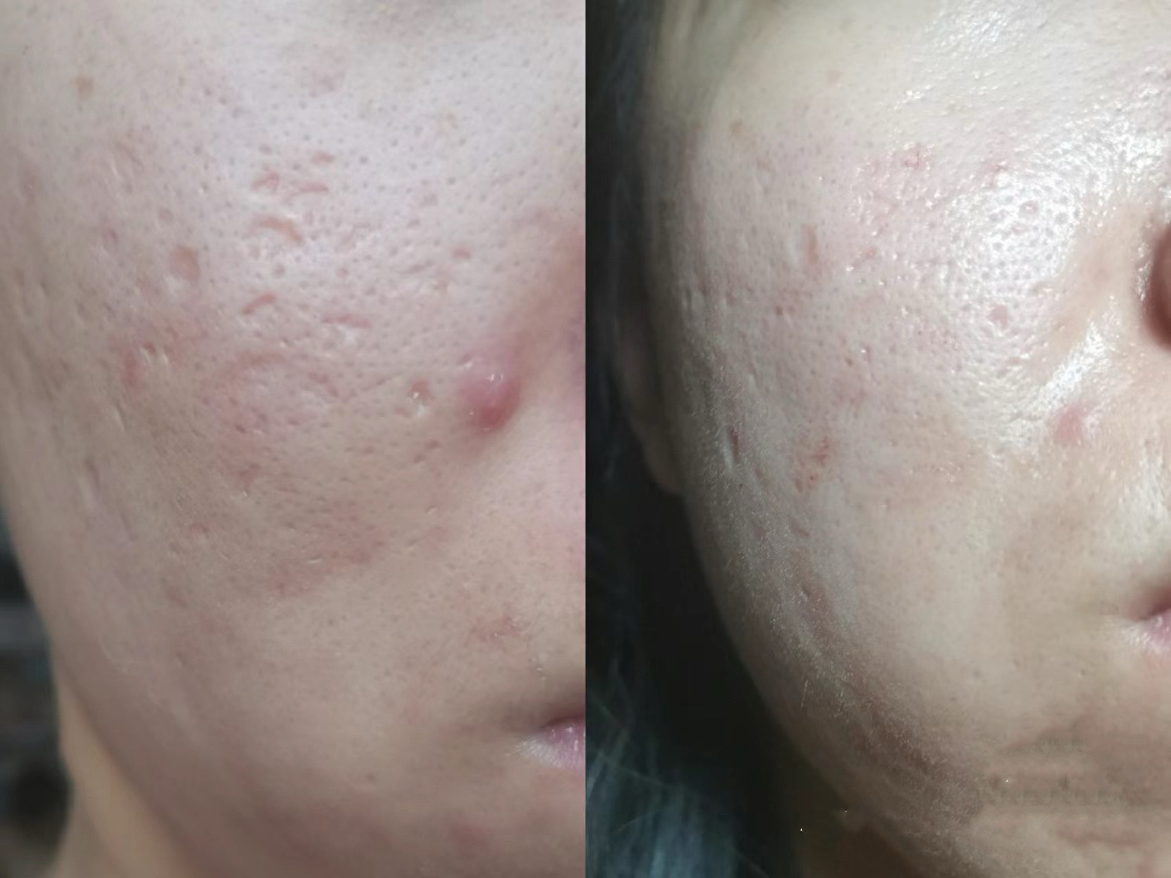 整形美容的点阵激光（点阵激光美容仪有效
吗）《点阵激光美容仪器》