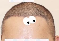 -大麦微针植发全国连锁