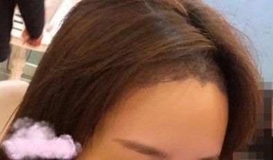 -大麦微针植发丨全国连锁