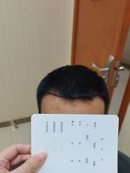 -碧莲盛·不剃发植发