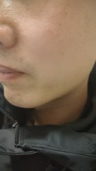 体验后-北京美痣堂古方祛痣斑疣瘊