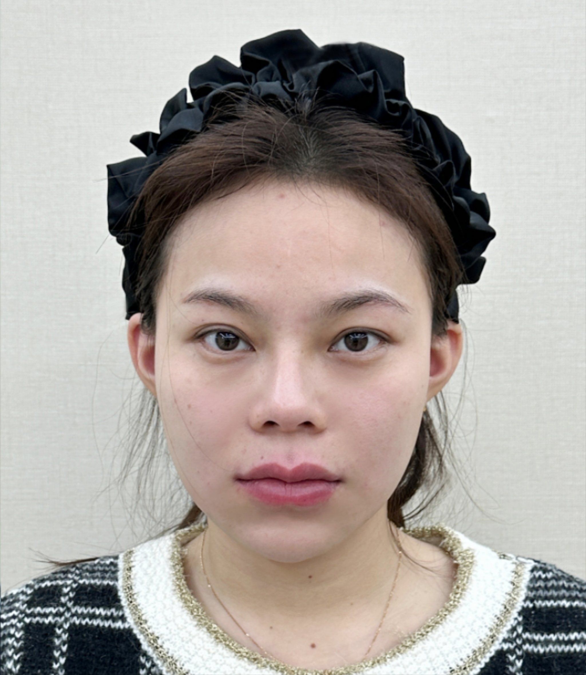 润致双相5号玻尿酸全脸打造体验后即刻效果分享