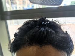 -碧莲盛·不剃发植发