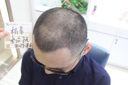 点击看大图 -大麦微针植发丨全国连锁