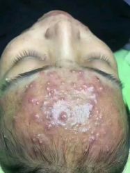 -瑶芳清颜草本祛痘