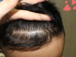 -大麦微针植发丨全国连锁