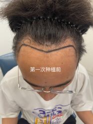 点击看大图 体验前-大麦微针植发全国连锁