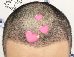 -大麦微针植发全国连锁