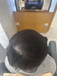 点击看大图 -大麦微针植发丨全国连锁