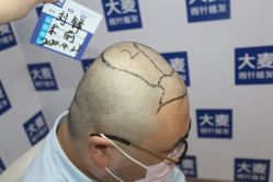 点击看大图 -大麦微针植发丨全国连锁