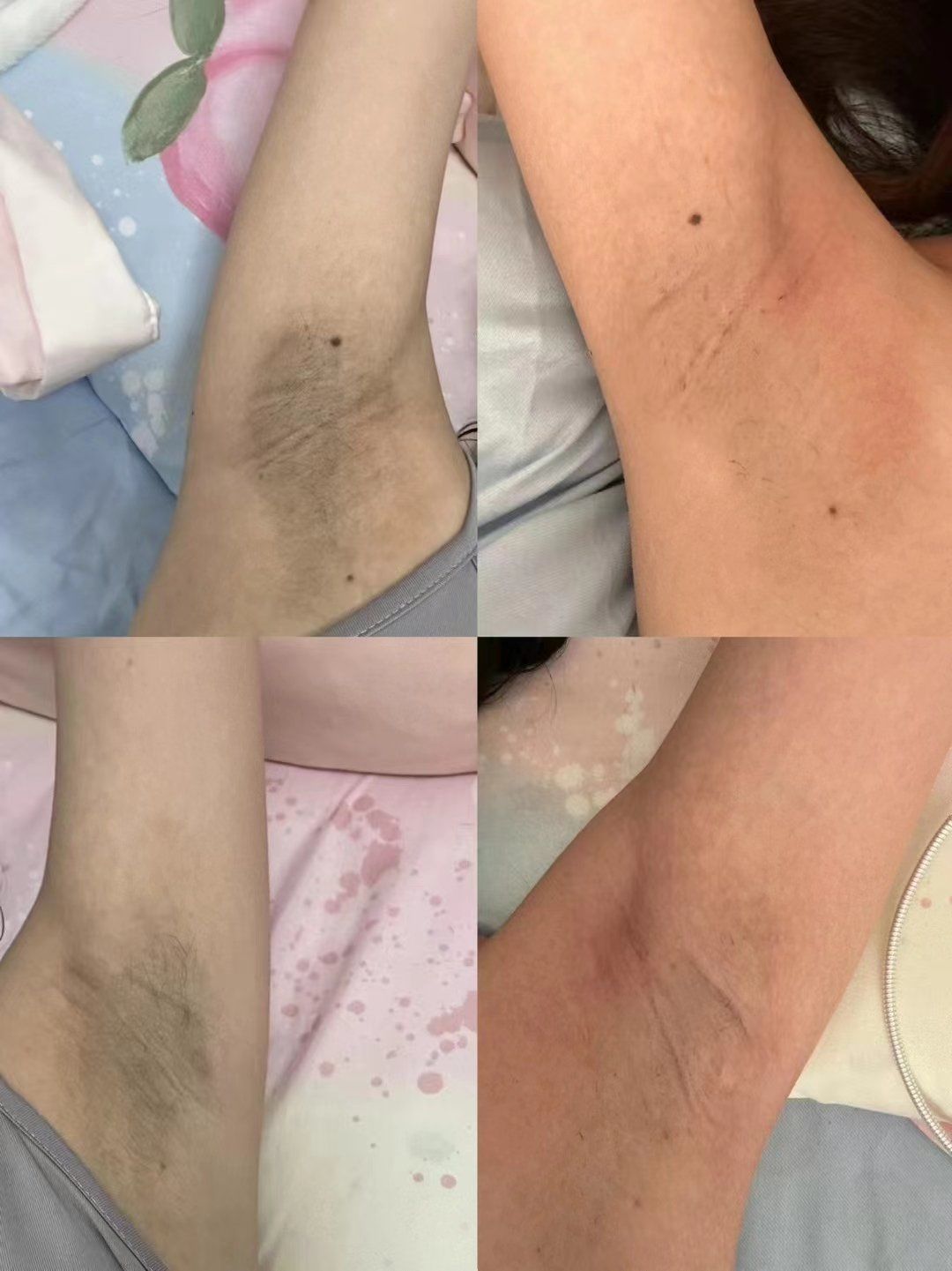 实现腋下自由低成本美白#腋下黑色素沉淀